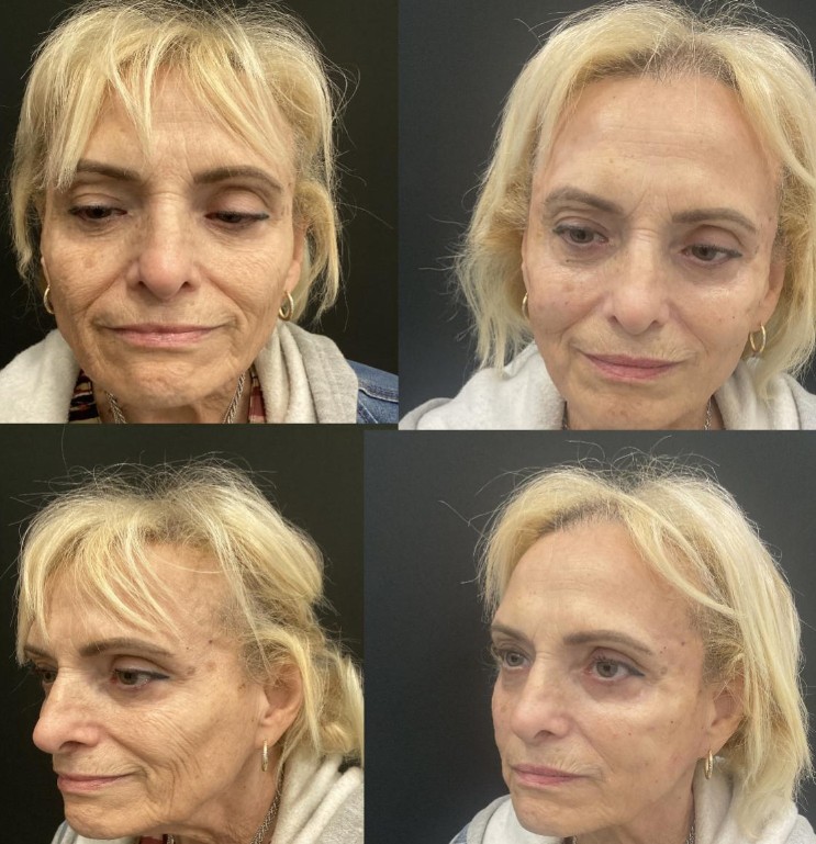 Face Fillers Before and After