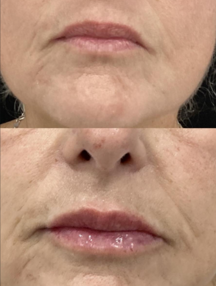 Lip Fillers Before and After