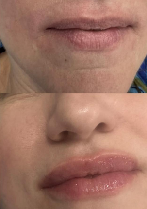 Lip Fillers Before and After