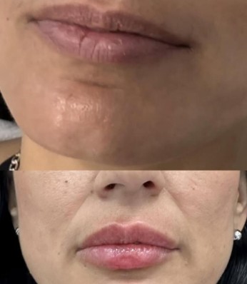 Lip Fillers Before and After