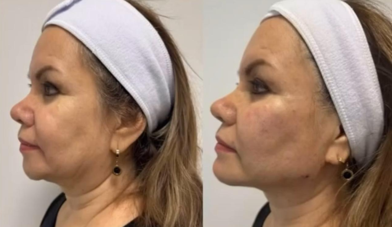 Fillers and PDO Threads Before and After